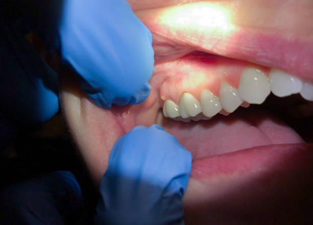Best Emergency Root Canal Treatment in Zilwaukee, MI